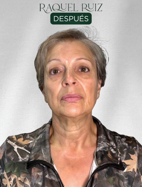 Tratamiento Fhos en Raquel Ruiz Estética