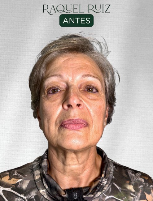 Tratamiento Fhos en Raquel Ruiz Estética